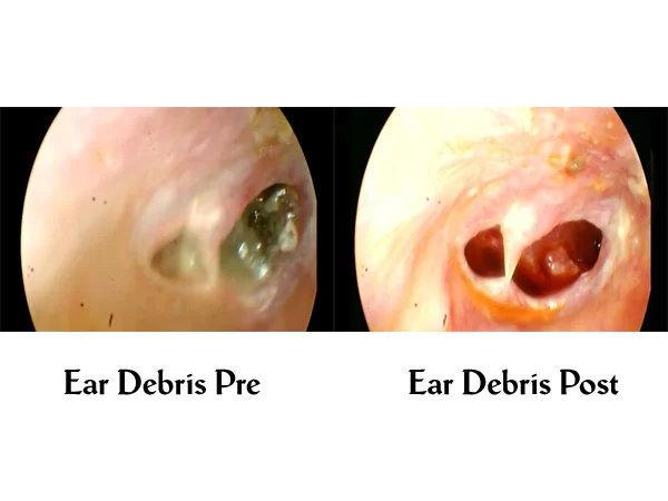 Ear Debris