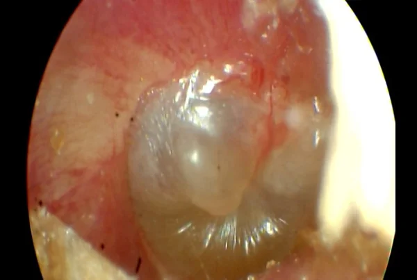 Extensive Serous Otitis