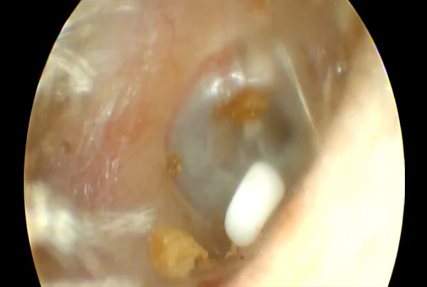 Foriegn Body in Ear