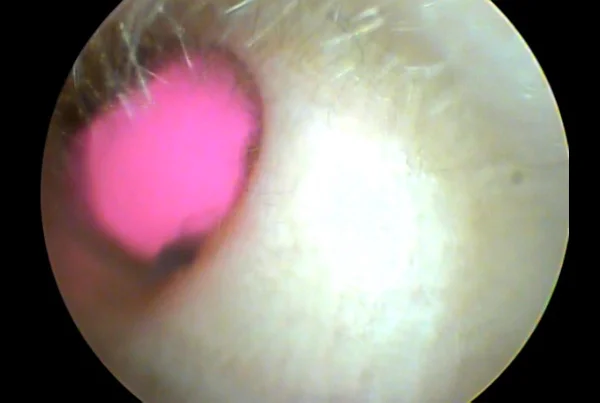 Foriegn Body in Ear