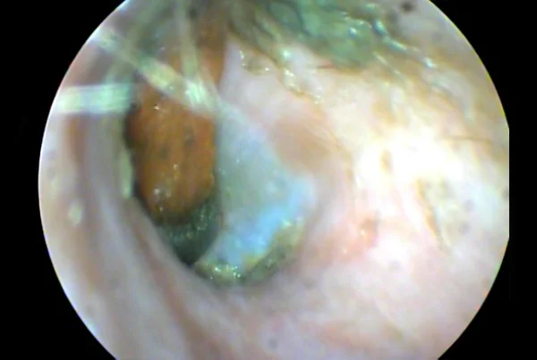 Foriegn Body in Ear