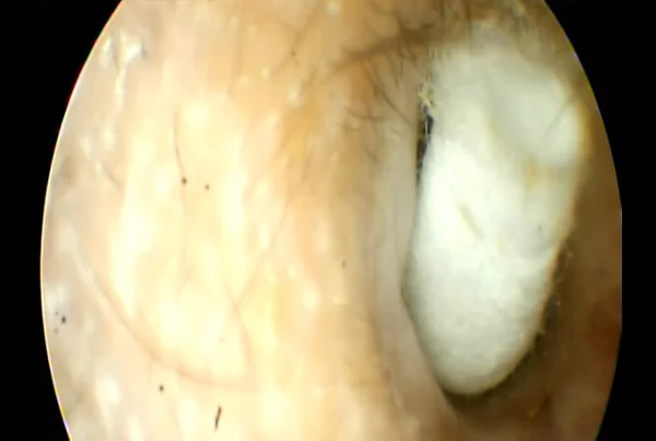 Foriegn Body in Ear