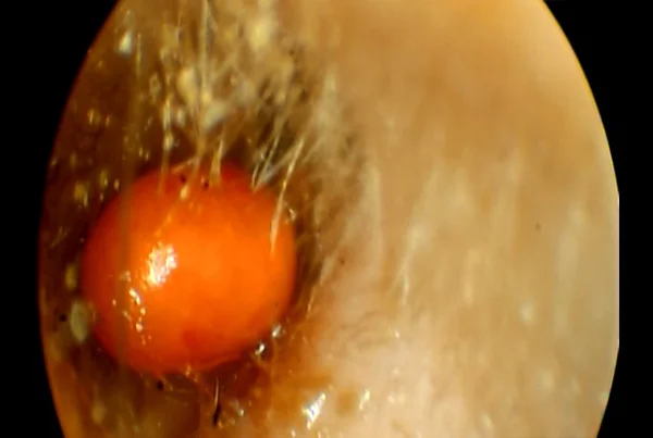 Foriegn Body in Ear