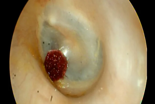 Foriegn Body in Ear