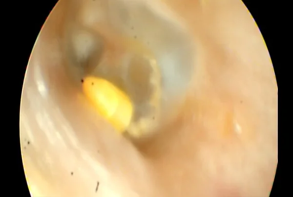 Foriegn Body in Ear