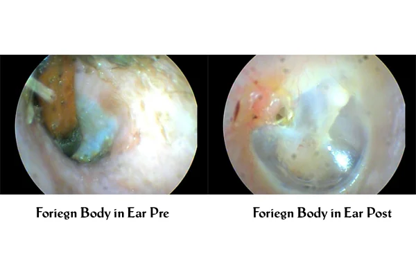 Foriegn Body in Ear
