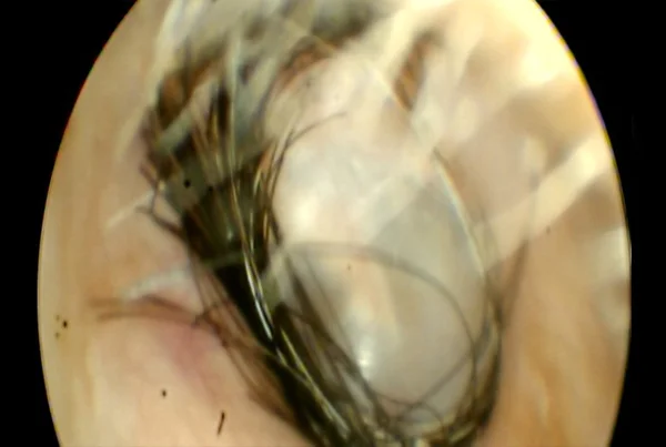 Hairs in Ear Due To Excessive Ear Cleaning