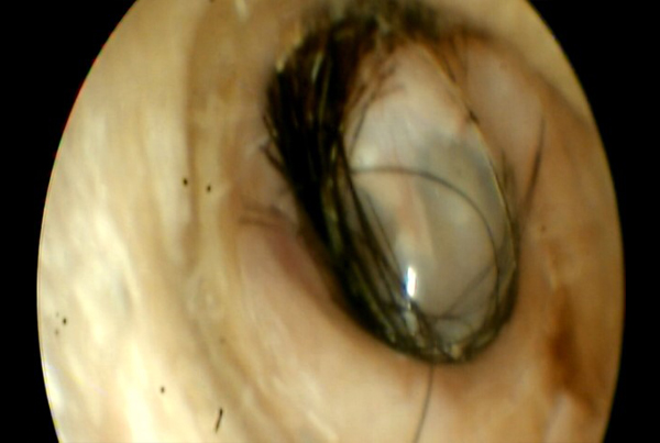 Hairs in Ear Due To Excessive Ear Cleaning