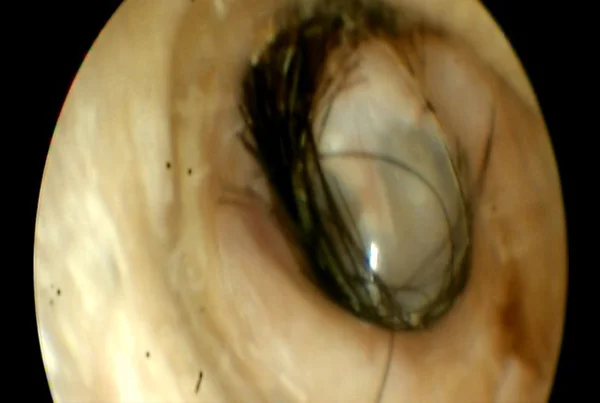 Hairs in Ear Due To Excessive Ear Cleaning