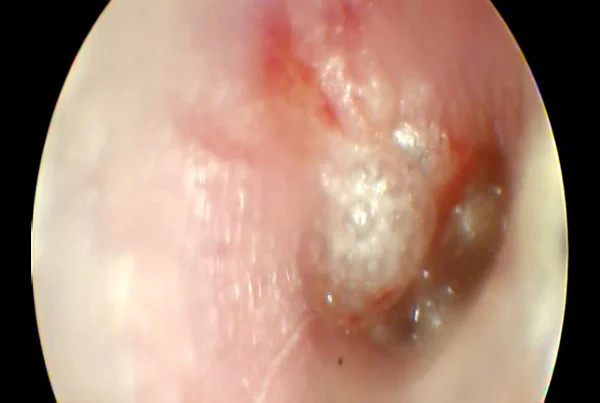 Serous Otitis