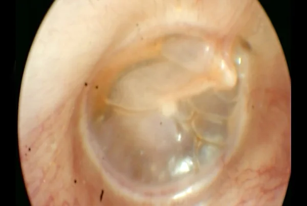 Serous Otitis