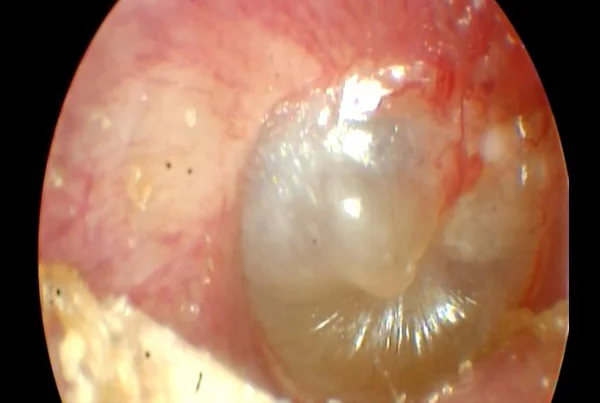 Serous Otitis