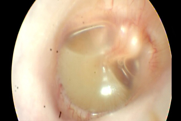 Serous Otitis