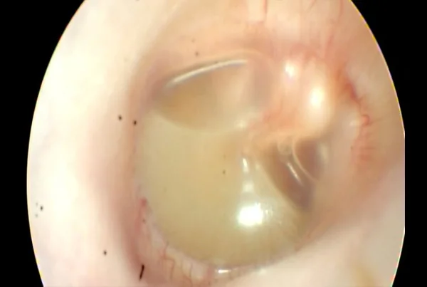 Serous Otitis