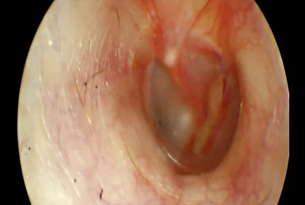 Traumatic Tympanic Membrane Perforation
