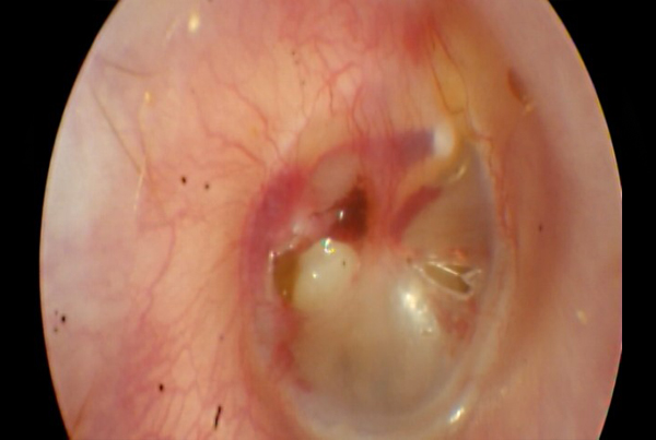 Traumatic Tympanic Membrane Perforation