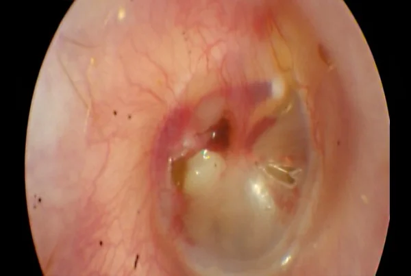 Traumatic Tympanic Membrane Perforation