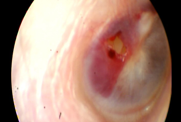 Traumatic Tympanic Membrane Perforation