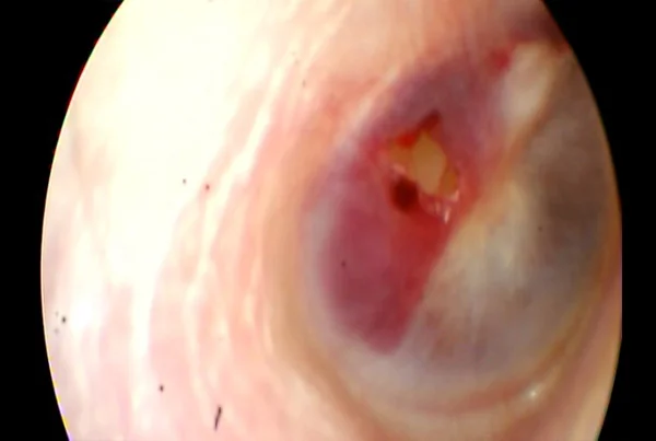 Traumatic Tympanic Membrane Perforation