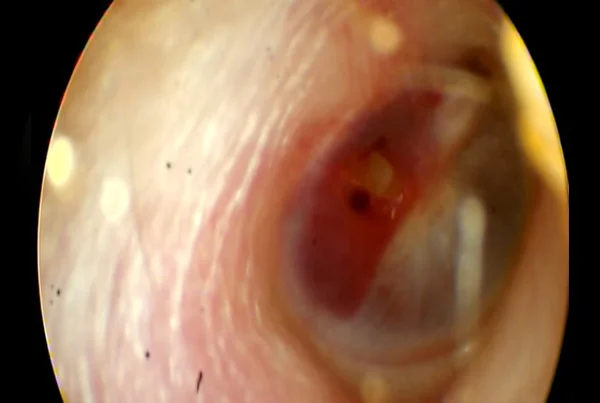 Traumatic Tympanic Membrane Perforation