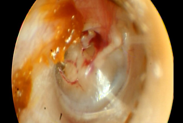 Traumatic Tympanic Membrane Perforation