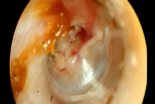 Traumatic Tympanic Membrane Perforation