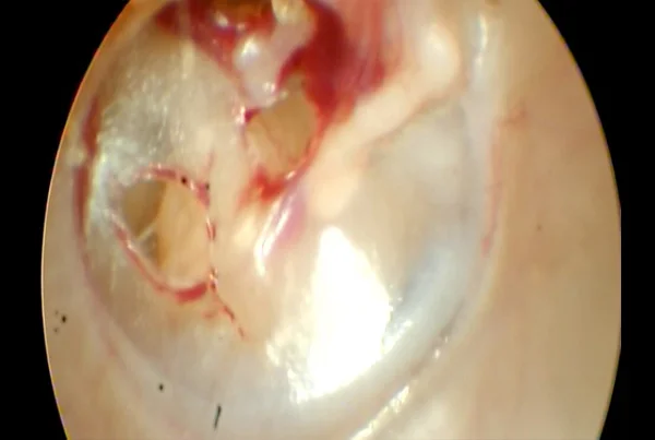 Traumatic Tympanic Membrane Perforation