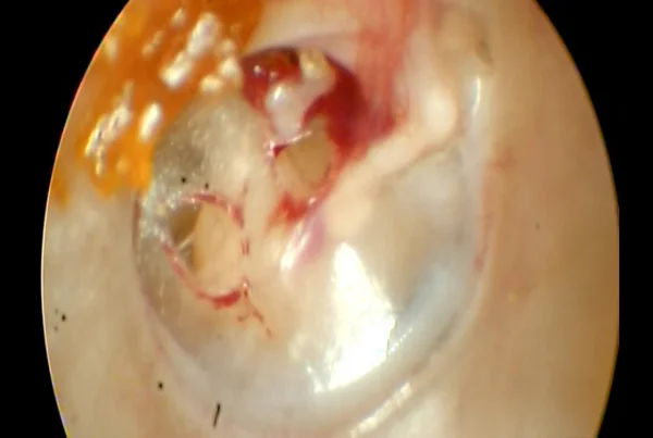Traumatic Tympanic Membrane Perforation