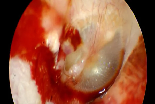 Traumatic Tympanic Membrane Perforation