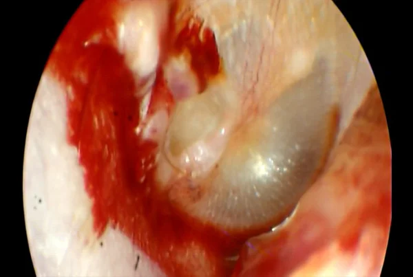 Traumatic Tympanic Membrane Perforation