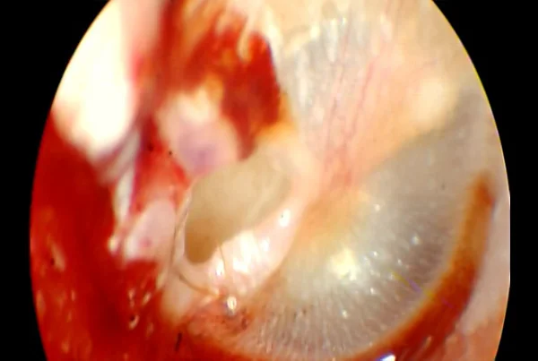 Traumatic Tympanic Membrane Perforation
