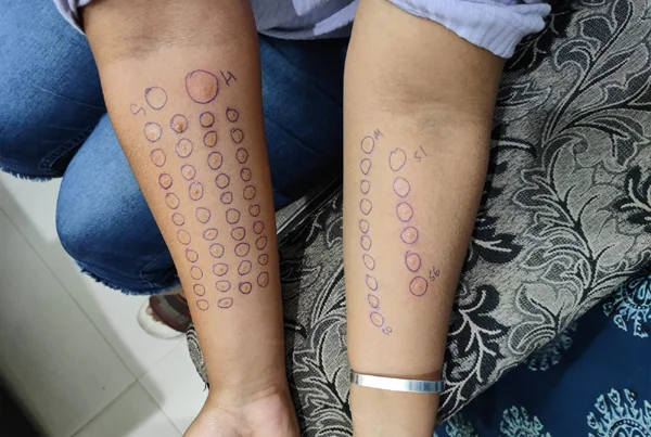 Allergy Testing