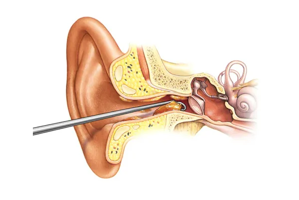Ear Wax Removal