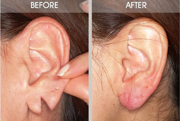 Ear Lobule Repair