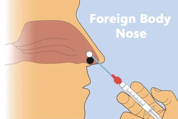 Foreign Body Removal