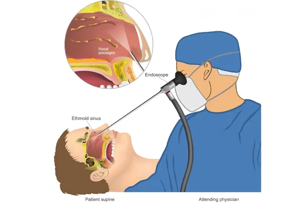 Endoscopic Surgery of ENT