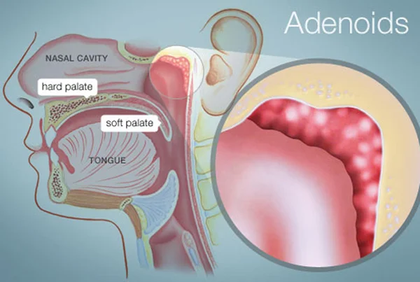 Adenotonsillectomy