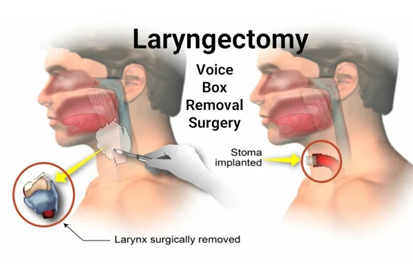 Laryngeal Surgery